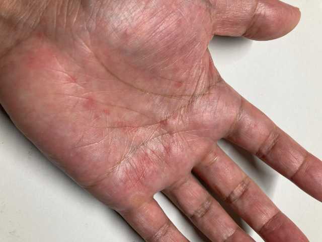 蕁麻疹 (手の平)