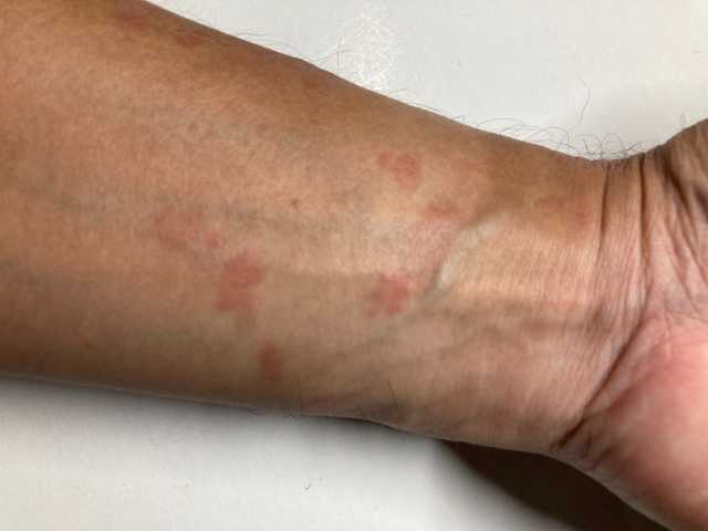 蕁麻疹（腕）