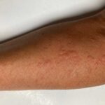蕁麻疹（腕）