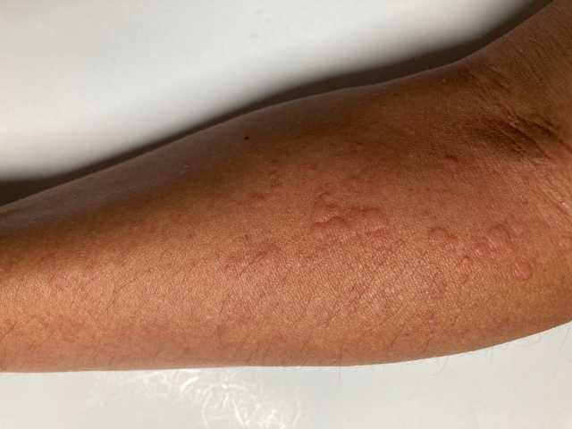 蕁麻疹（腕） 
